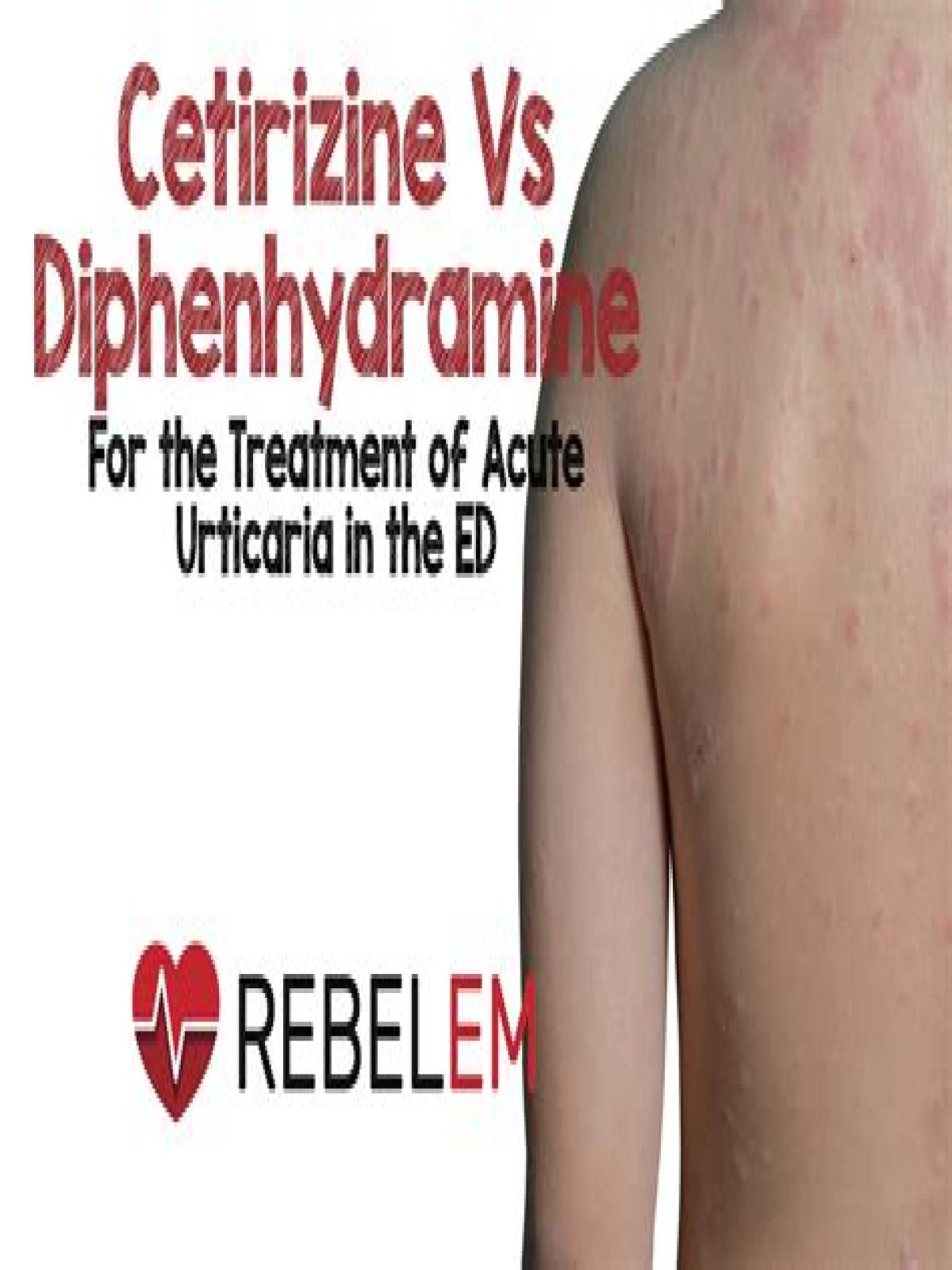 Are diphenhydramine and cetirizine the same thing?