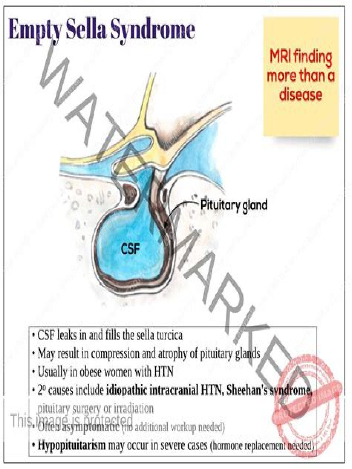Is empty sella syndrome life-threatening?