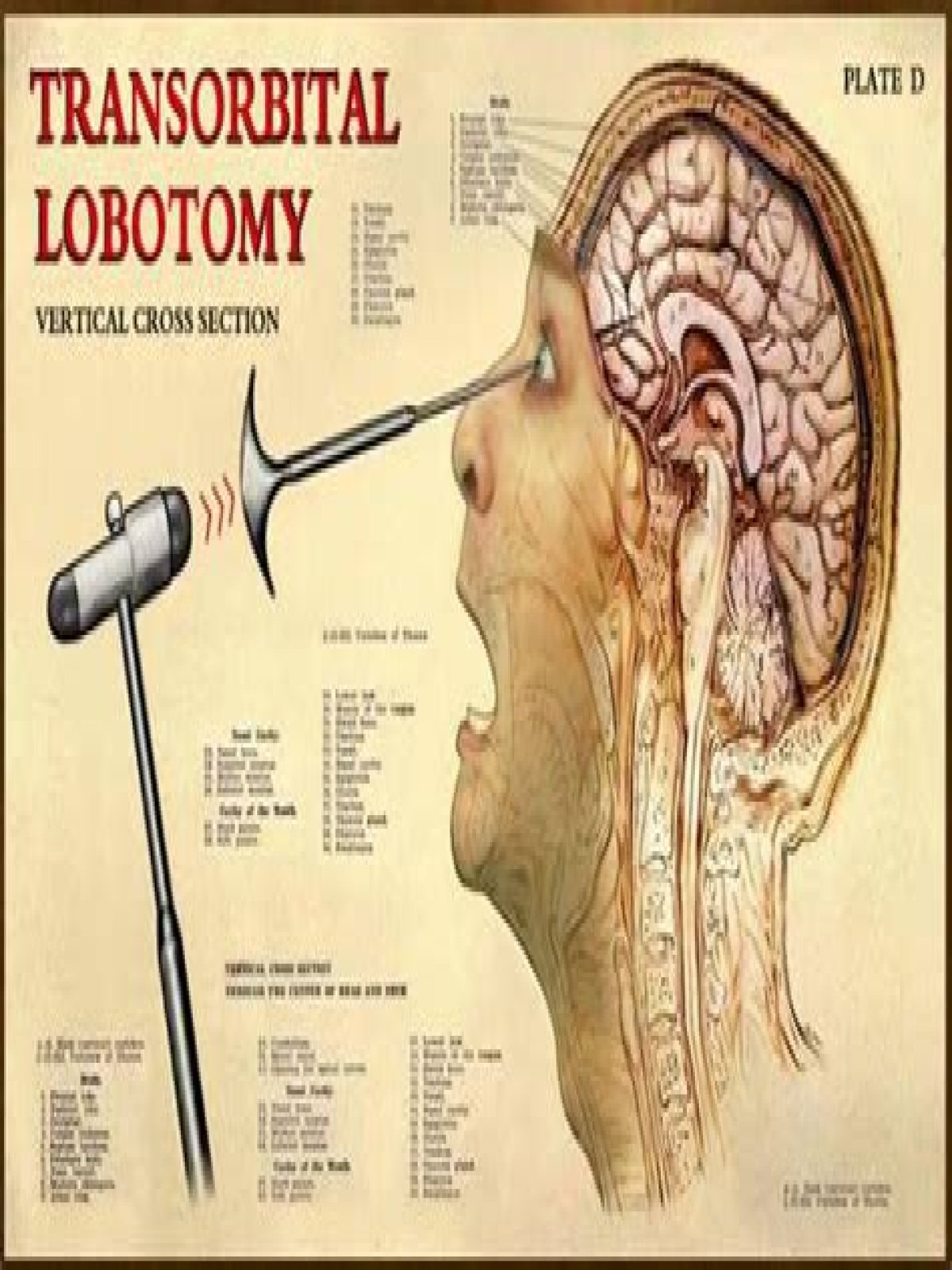 Is lobotomy same as lobotomy?